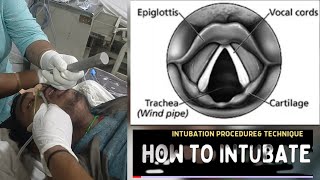 HOW TO INTUBATE INTUBATION PROCEDURE amp TECHNIQUE [upl. by Nea]