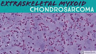 Extraskeletal Myxoid Chondrosarcoma 5Minute Pathology Pearls [upl. by Finkelstein]