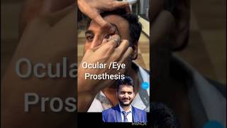 Eye prosthesis ocular prosthesis eye injury vision shorts [upl. by Neerbas]