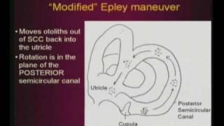 Epley Maneuver [upl. by Oyr788]