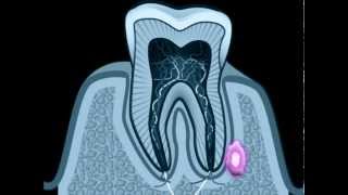 Cisti dentale  cisti radicolare [upl. by Eehsar]