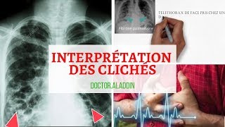 Cancer Bronchiqe  Maitriser linterprétation des clichés [upl. by Wolfe430]