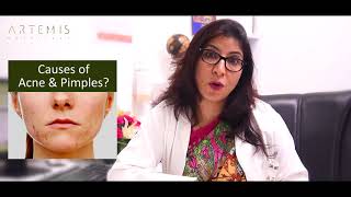 CAUSES OF ACNE amp PIMPLES [upl. by Glasgo]