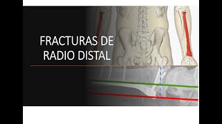 FRACTURA DE RADIO DISTAL [upl. by Parrnell45]