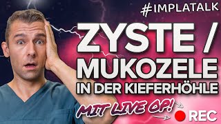 Zyste  Mukozele in der Kieferhöhle 🆘 Was tun Wir erklären die Ursachen amp Therapie inkl Live OP [upl. by Ibot]