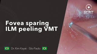 Fovea sparing ILM peeling  Vitreomacular traction [upl. by Trinee]