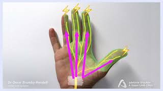 What is Carpal Tunnel Syndrome Answered by Orthopaedic Surgeon  Dr Oscar BrumbyRendell [upl. by Chaker]