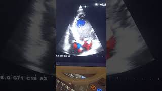 Severe LV dysfunctionseverely dilated left Ventricle [upl. by Zailer]