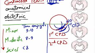 contracted pelvis [upl. by Notsahc]