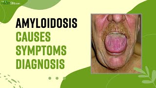 Amyloidosis What Is This Rare Disease Causes Symptoms amp Treatment Of The Amyloidosis [upl. by Maclaine]