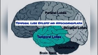 Temporal lobe epilepsy and hypochondroplasia [upl. by Yert]