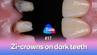 Zicrowns on dark teeth  BG Dental Cases 17 [upl. by Sharity]