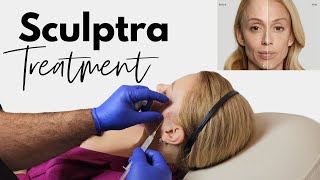 Revitalize Your Look The Ultimate Guide to Sculptra Treatments [upl. by Aciruam]