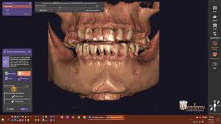 exoplan v30 Galway  Defining CT Densities [upl. by Garzon]