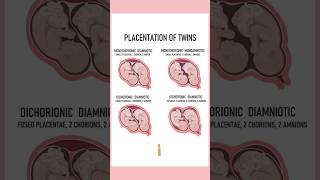 4 Types of twins medically Twin pregnancies pregnant youtubeshorts twins September 4 2024 [upl. by Ettenad]