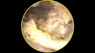 Tympanic membrane perforation and postoperative debridement for cholesteatoma 58 [upl. by Terrej182]