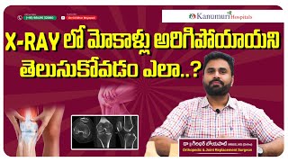 XRAY లో మోకాళ్లు అరిగిపోయాయని తెలుసుకోవడం ఎలా  How to read knee joint Xray in knee osteoarthritis [upl. by Bollen447]