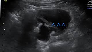 On Call USG  Dr Sanjeev Mani  URINOMA  SUBCAPSULAR  PERINEPHRIC COLLECTIONS  ACUTE RENAL COLIC [upl. by Kurt]