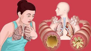 Cough Variant Asthma Causes And Symptoms [upl. by Alurta470]