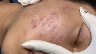 ACNE TREATMENT VU QUYNH MI Acne On Boys Cheek 2024 [upl. by Alihet]