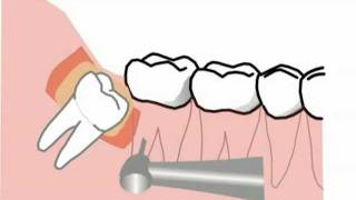 spezielle Komplikationen bei der Weisheitszahnentfernung neue Version [upl. by Kowtko945]
