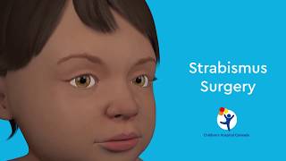 What is Strabismus Surgery [upl. by Suilienroc862]