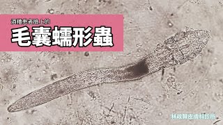 酒糟患者臉上的蠕形蟲 蠕形蟎；demodex [upl. by Ecirtnahs808]