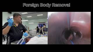 Flexible Bronchoscopy Foreign Body Removal [upl. by Enyamrahc]