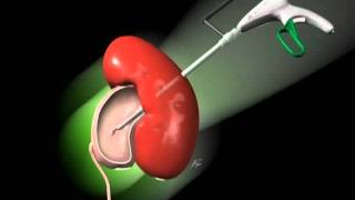 Categoria Endourologia  ENDOUROLOGIA  PERCUTÂNEA  8 pieloplastia percutânea [upl. by Nov]