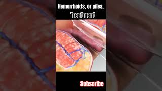 Hemorrhoids or piles surgery and treatment 3danimation viral short [upl. by Ainatnas401]