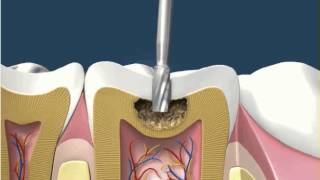 Dental Fillings White Amalgam 1 [upl. by Timothy104]