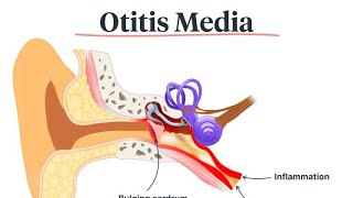 Otitis Media إلتهاب الأذن الوسطى [upl. by Roselin]