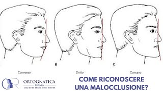 Come riconoscere una malocclusione dentoscheletrica [upl. by Kaz]