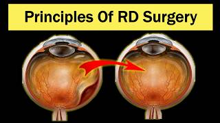 How to treat Retinal Detachment [upl. by Burrus965]