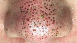 Big Cystic Acne Blackheads Extraction Blackheads amp Milia Whiteheads Removal Pimple Popping [upl. by Aniluj254]