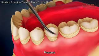 Teeth scaling to remove plaque  3d animated video  Dental Solutions Clinic Bangalore [upl. by Alison]