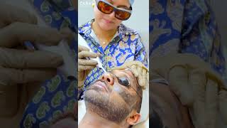 Pico Laser Best Way to Remove Tan and Get Glowing Skin [upl. by Daphene]