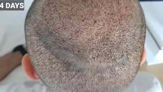 FUE Hair Transplant Timeline  Month 1 to 6  Before amp After [upl. by Sirron290]