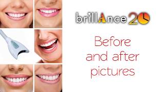 Brilliance 20 Inoffice whitening how to take before amp after pictures [upl. by Hoseia62]