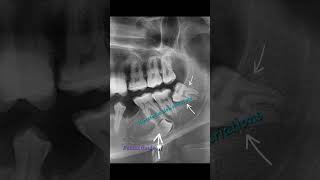 Sharp bending severe curvatures and dilacerated roots of permanent third molars surgical exodontia [upl. by Burrows]