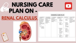 Nursing Care Plan on Renal Calculusrenalcalculi NCP ON RENAL CANCULI [upl. by Dowlen]