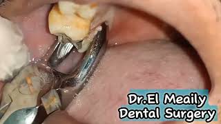 Exodontia Badly Decayed Upper Molar [upl. by Flita]