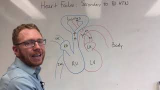 Exam Question  Heart failure Secondary to COPD [upl. by Rausch]