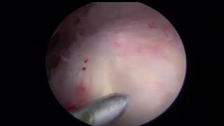 Calcific Tendonitis of the Rotator Cuff  Arthroscopic Treatment  Shoulder Surgeon Vail CO [upl. by Meris]