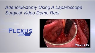 Adenoidectomy Surgical Video [upl. by Dreddy]