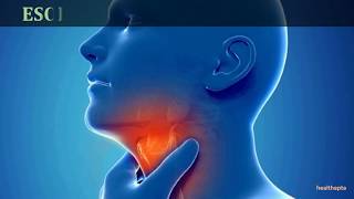 SYMPTOMS AND SIGNS OF ESOPHAGEAL CANCER [upl. by Bromleigh]