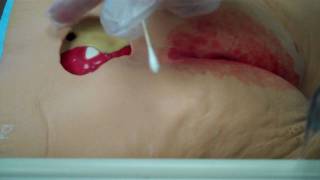 Sterile WettoDry Dressing Changewmv [upl. by Belda]