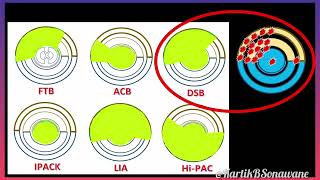 Exploring ProcedureSpecificity of the Dual Subsartorial Block DSB [upl. by Chastity]