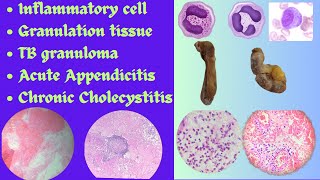 Inflammatory cell Granulation tissue TB granuloma Appendicitis Cholecystitis identificationExam [upl. by Eener]