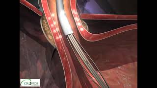 Procedimento Endoscópico Para Tratamento da Doença do Refluxo Gastroesofágico DRGE [upl. by Judson]